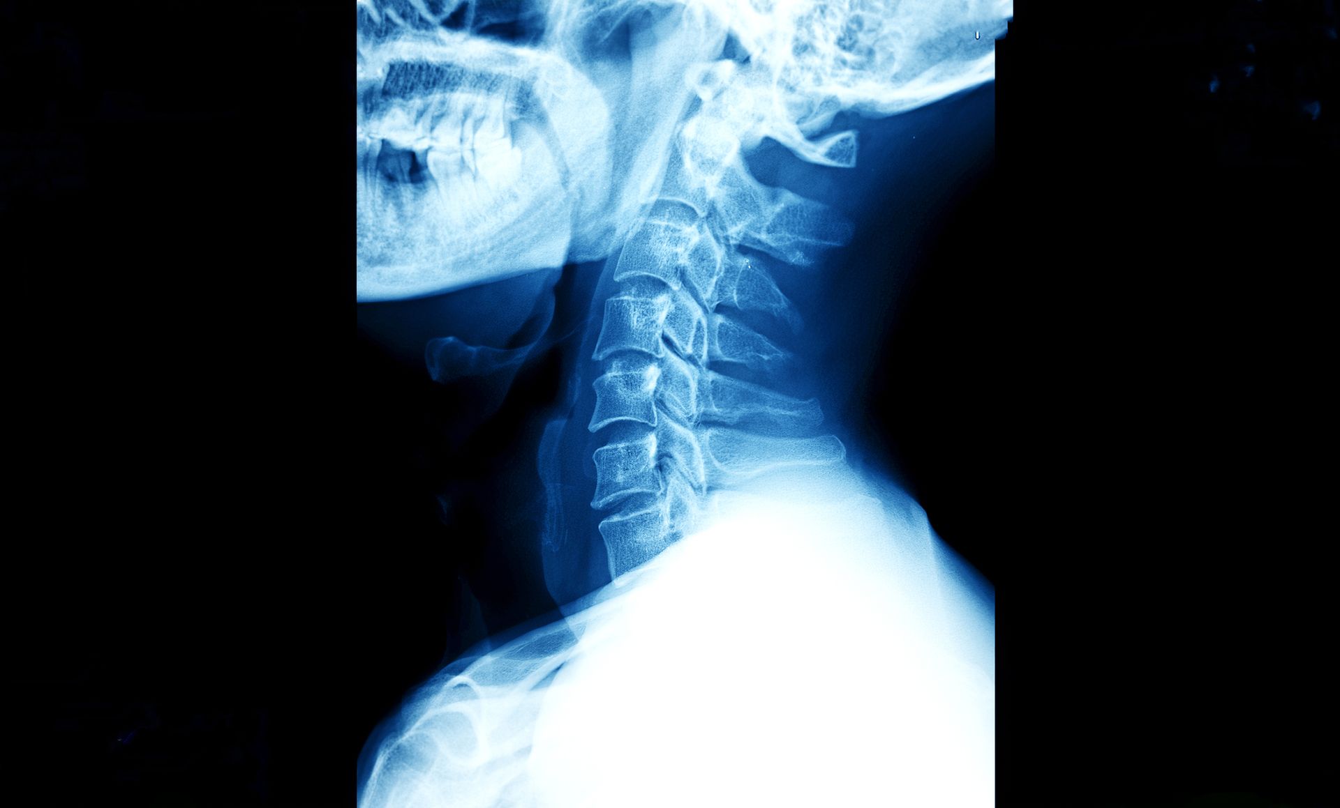 Cervical spine X-ray used to evaluate neck injuries and whiplash after a motor vehicle accident.