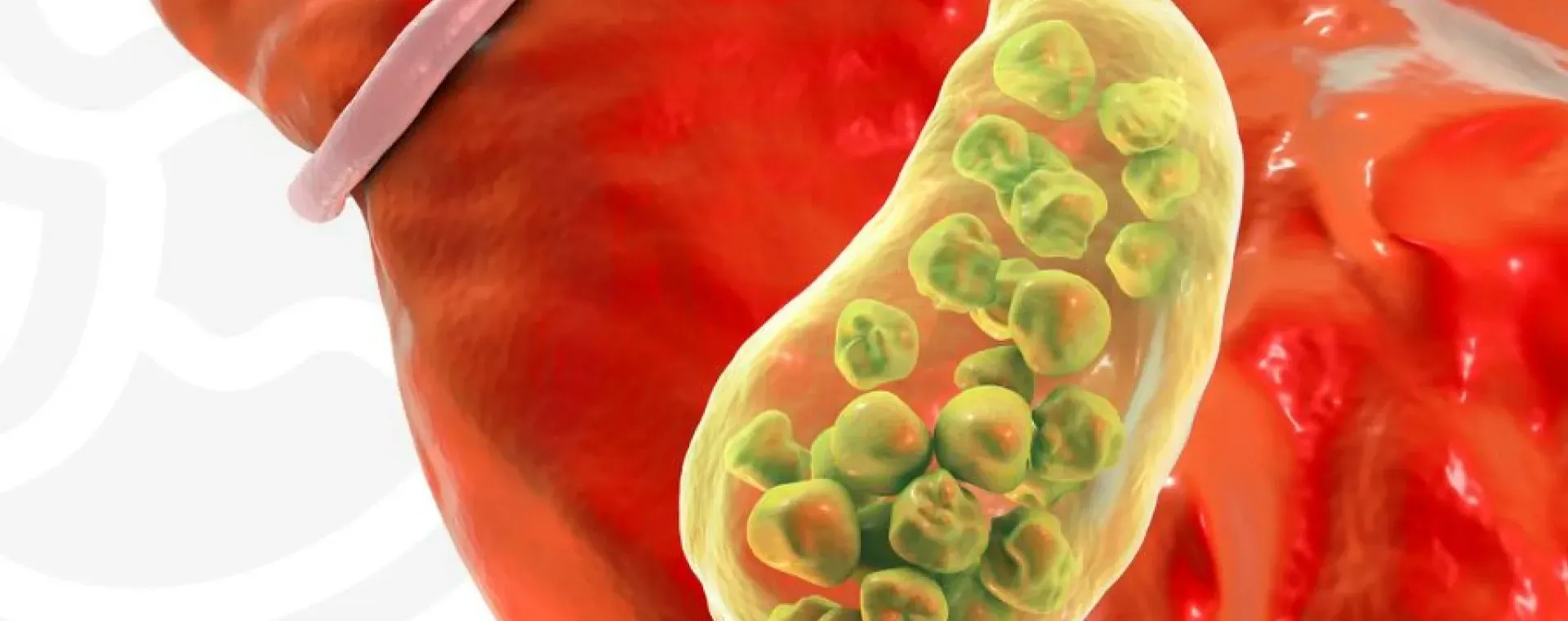 O QUE É COLANGIOCARCINOMA (CÂNCER DAS VIAS BILIARES)
