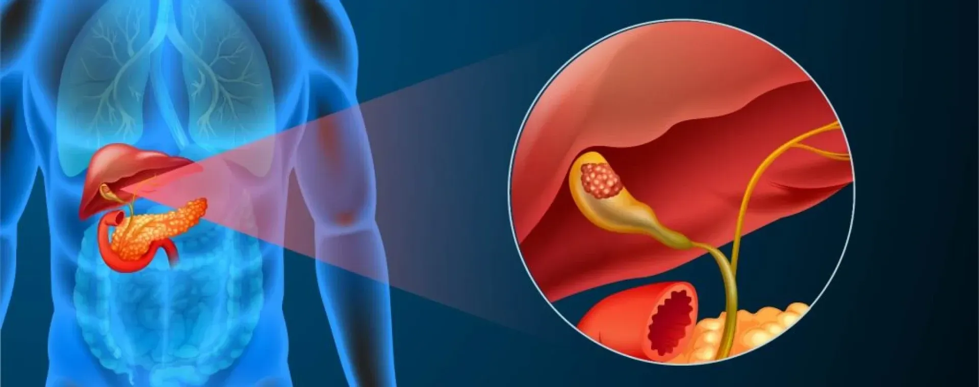 TRATAMENTO COLANGIOCARCINOMA (CÂNCER DAS VIAS BILIARES)