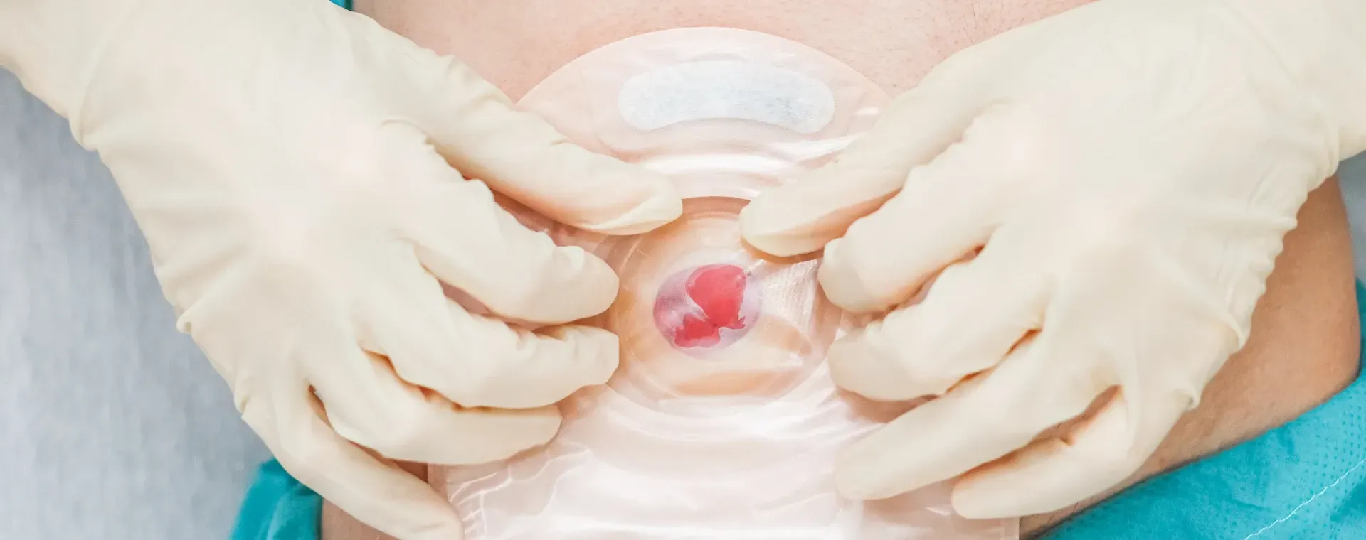 bolsa de colostomia