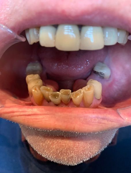 Close-up of an open mouth showing upper teeth and heavily decayed lower teeth with missing and discolored teeth