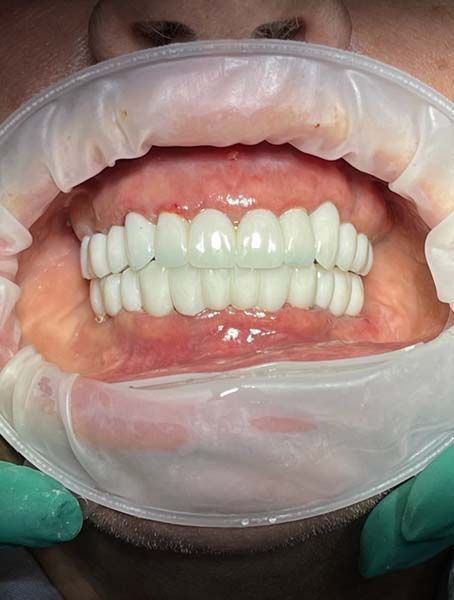 Close-up of dental prosthetic teeth fitted in a mouth, held open with cheek retractors and a protective bib