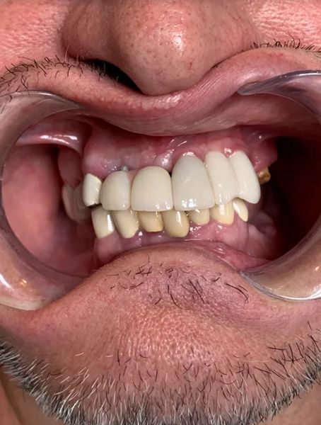 Close-up of a mouth with teeth visible, showing dental crowding and discoloration.