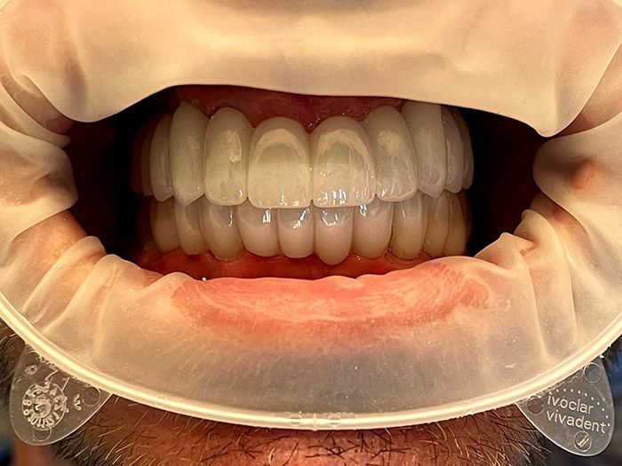 Dental close-up with retractors showing upper and lower front teeth and gums