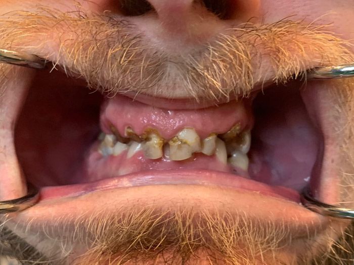 Close-up of a mouth with severe yellowed, crowded teeth and a mustache above and below the lips