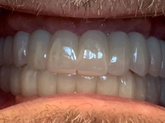 Close-up of glossy white teeth with braces-free smile, lips slightly parted.