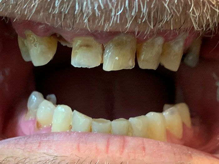 Close-up of a mouth with several yellowed, damaged teeth and gaps visible.