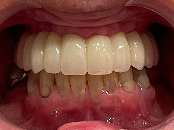 Close-up of teeth with dentures on top and natural lower teeth, showing gums and mouth.