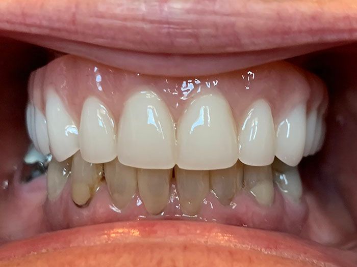 Close-up of a mouth showing upper teeth and discolored lower teeth with gums visible