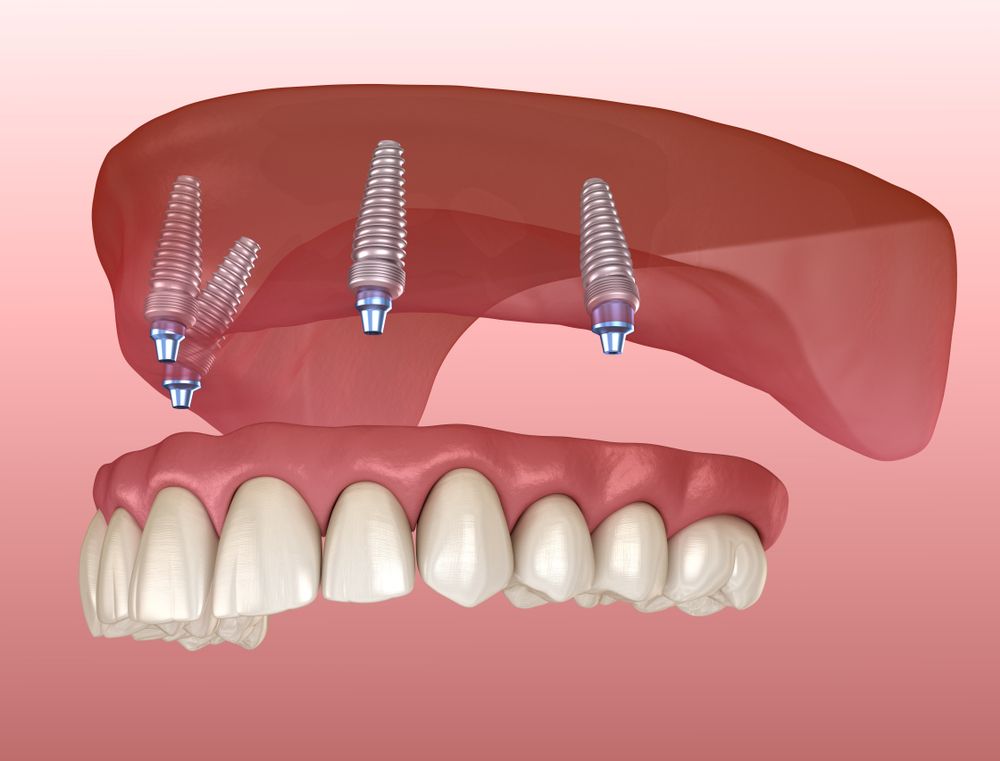 Illustration of upper jaw dental implants above a row of artificial teeth and pink gums