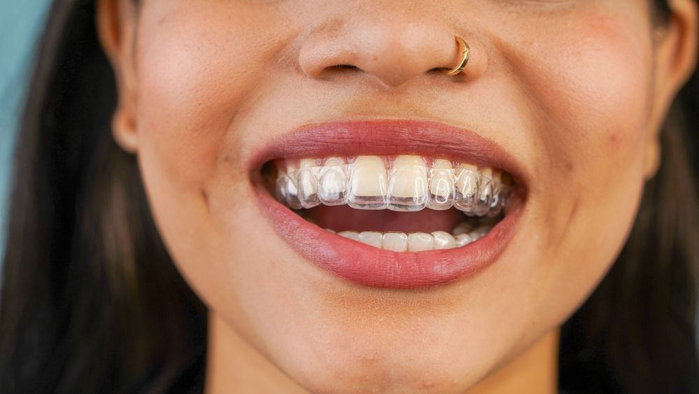Close-up of a smiling mouth with metal braces and a gold nose ring