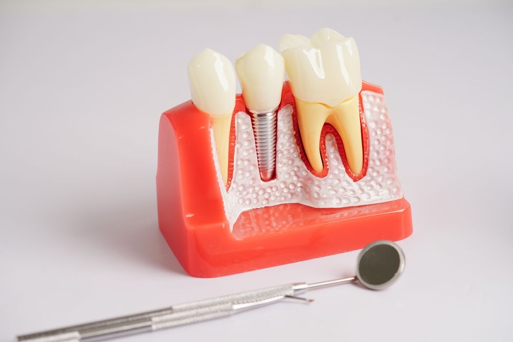 Dental model showing teeth with gum disease, with a dentist's mirror on a white background