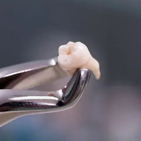 Tooth Extractions