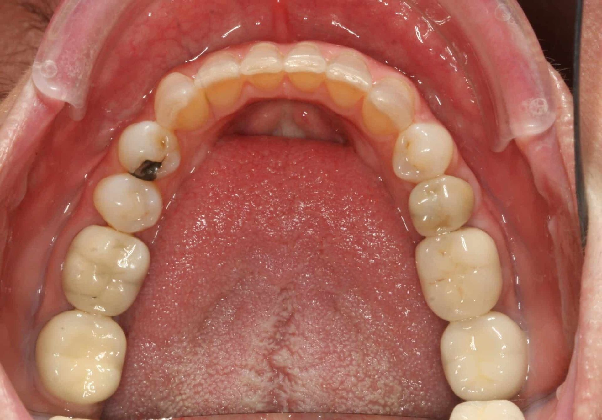 after invisalign