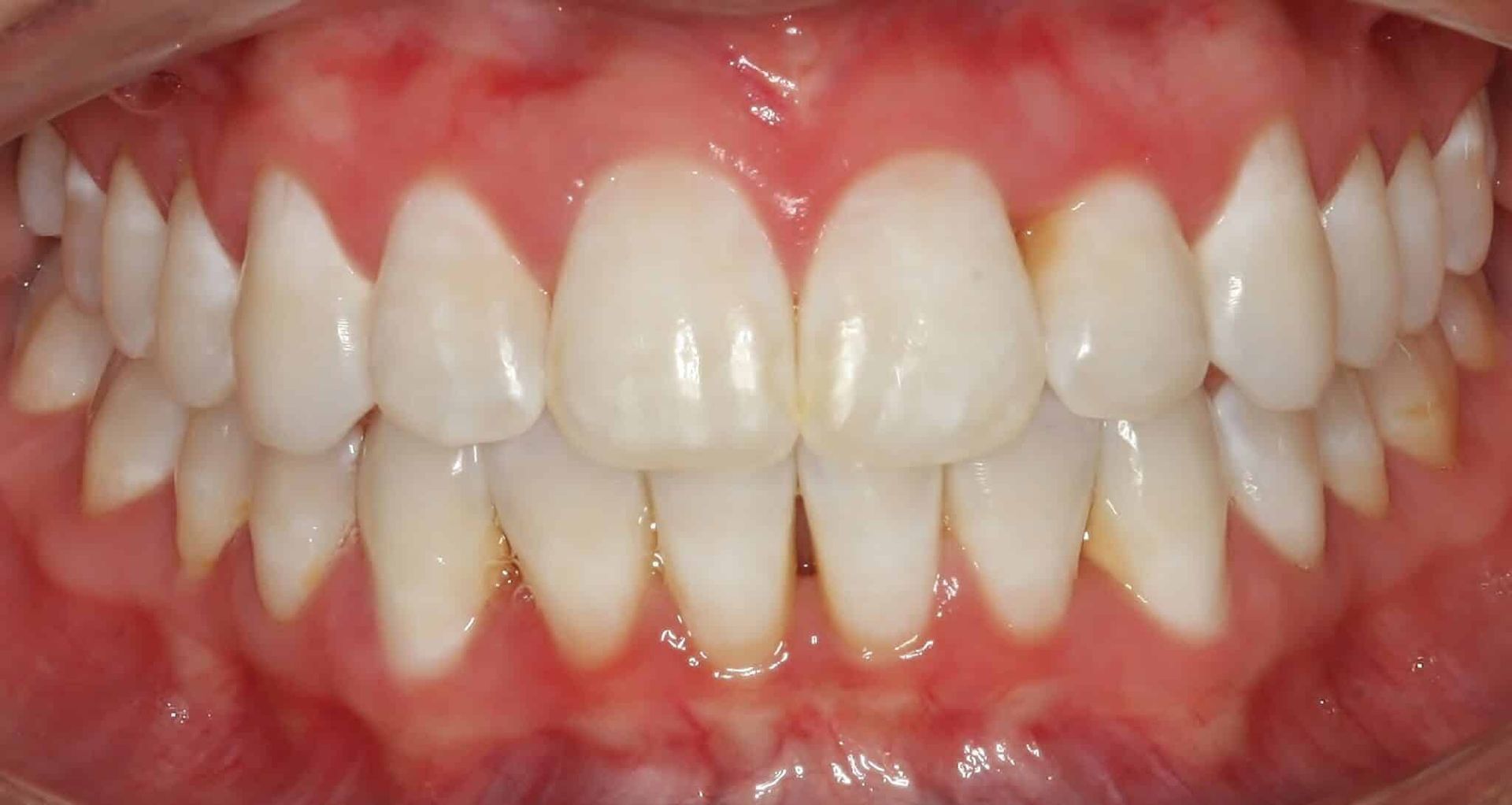 after clear braces