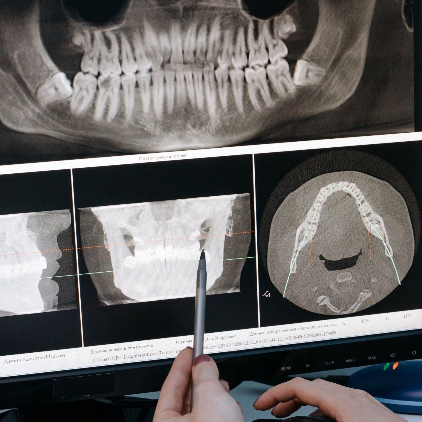 Root Canals