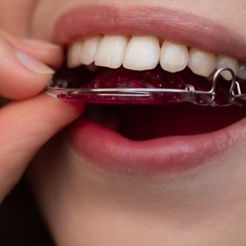 Dental Retainers