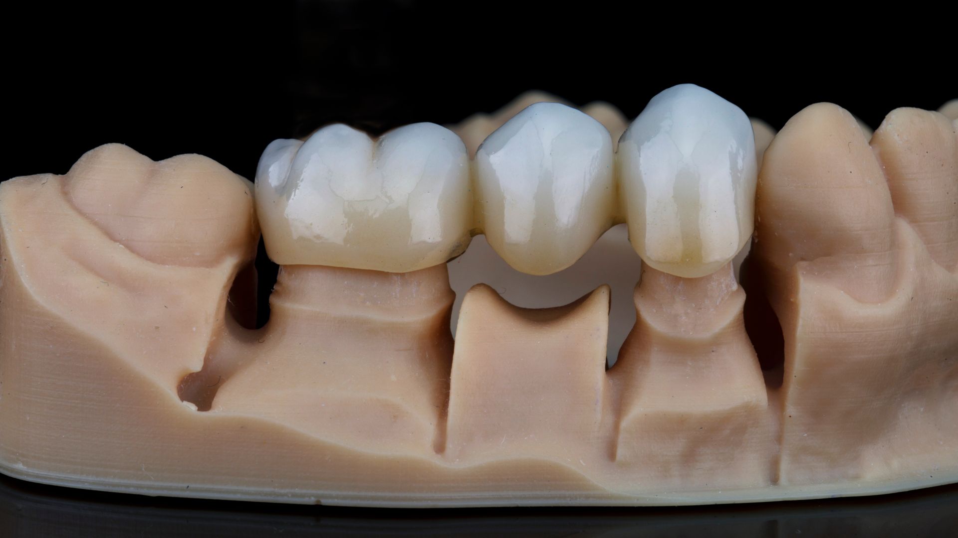 Dental model with white crowns and bridge on a beige gum base