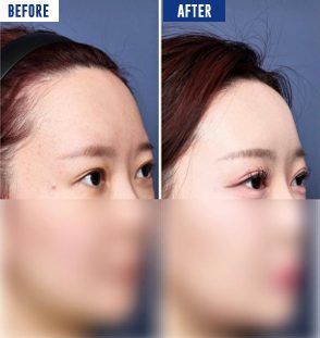 ソウル・ウィルビー整形外科の額縮小術（生え際の引き下げ）のビフォーアフター