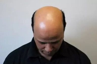 A man with a bald head is wearing a black shirt and looking down.