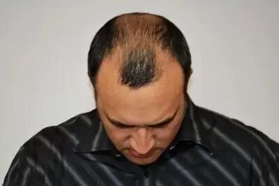 Before - men's hair loss