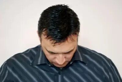 After - mens hair replacement system