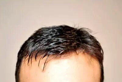 After - mens hair replacement system close up