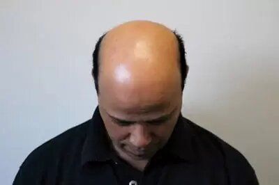 Before - men's hair loss
