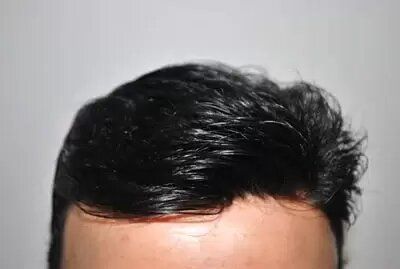 After - mens hair replacement system close up
