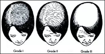 Three drawings of a woman 's head showing different stages of hair loss