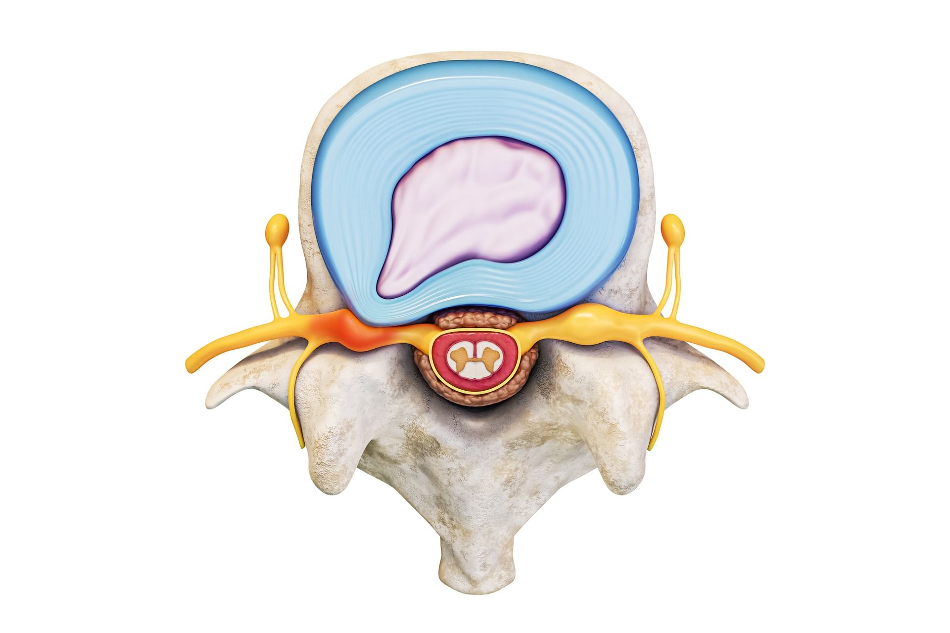 Lumbar Microdisectomy