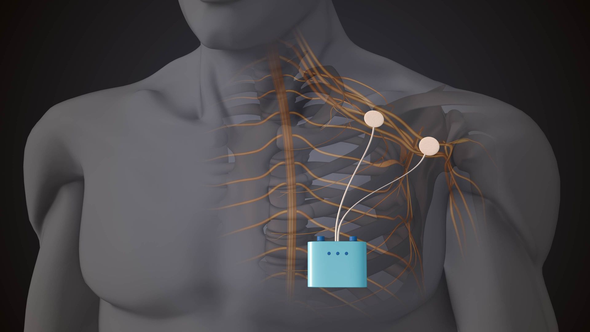 Peripheral Nerve Stimulation
