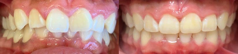 before and after 1