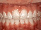 overbite after