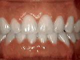 spacing of teeth after