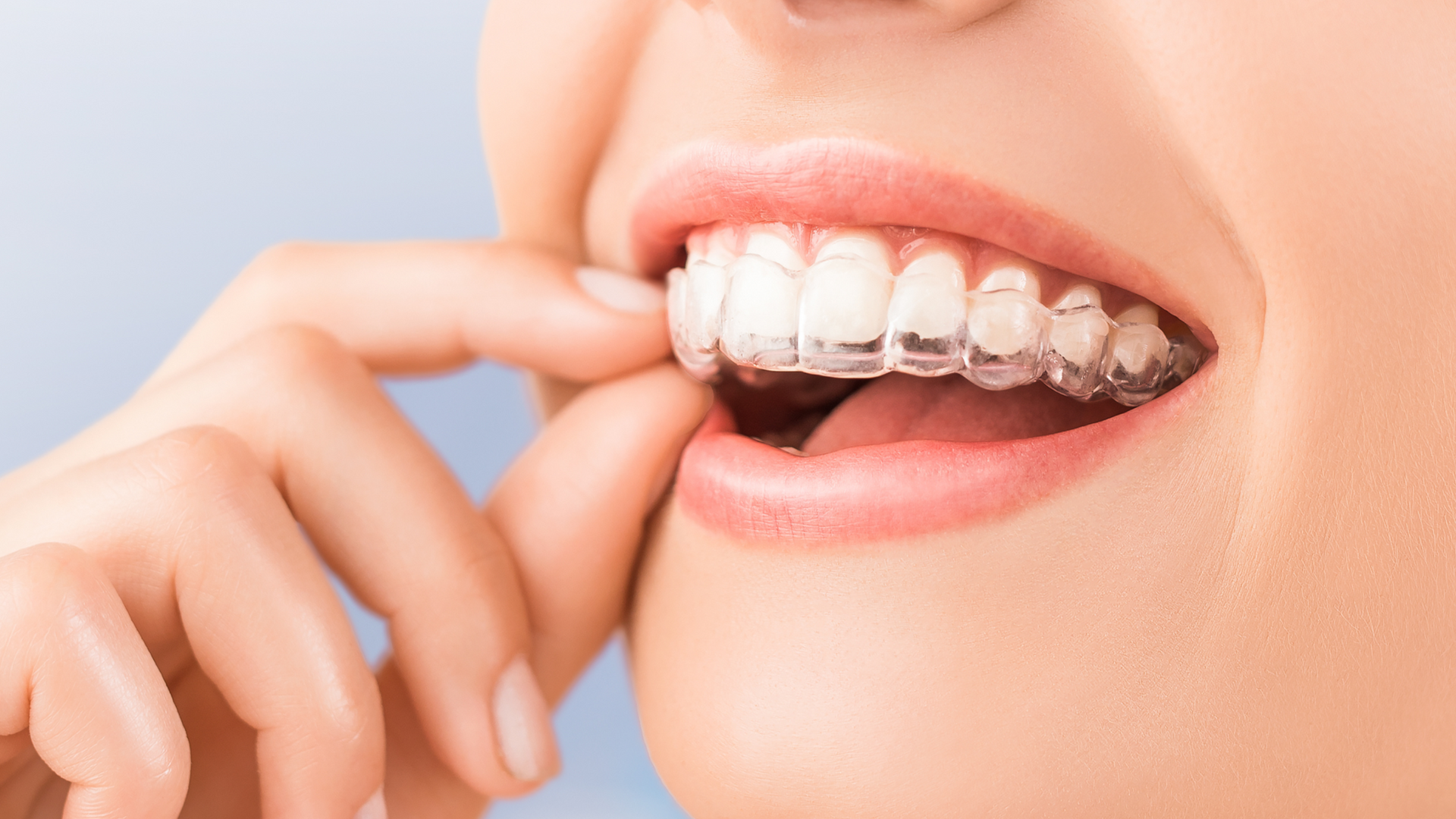 Aligner therapy