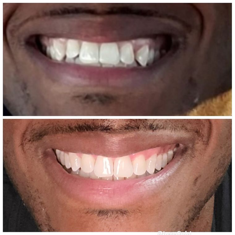 Teeth straightening in Louisville, Kentucky at Sparkle and Shine Dental