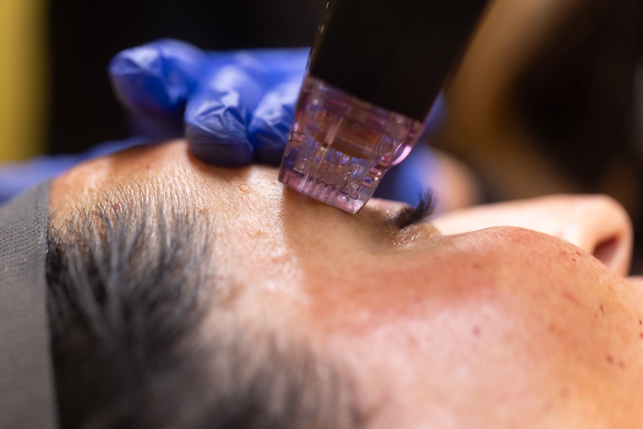 Close up shot of Morpheus8, working on eye brow. With blue gloves.