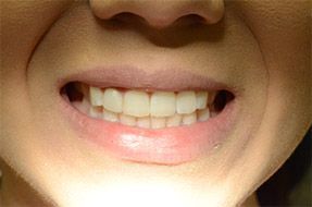 One of the most popular tray-based teeth straightening solutions, clear aligners La Plata MD, Invisalign A close up of a woman 's mouth with her teeth showing.
