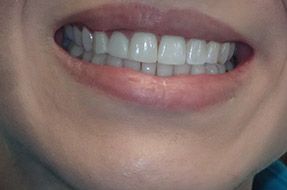One of the most popular tray-based teeth straightening solutions, clear aligners La Plata MD, Invisalign A close up of a woman 's mouth with white teeth.