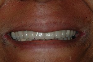 Visit Cieplak Dental if you are searching for smile makeover in La Plata, MD A close up of a man 's mouth with white teeth.