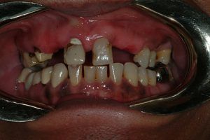Visit Cieplak Dental if you are searching for smile makeover in La Plata, MD A close up of a person 's mouth with a lot of teeth missing.