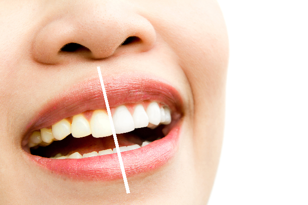Clareamento Dental Caseiro