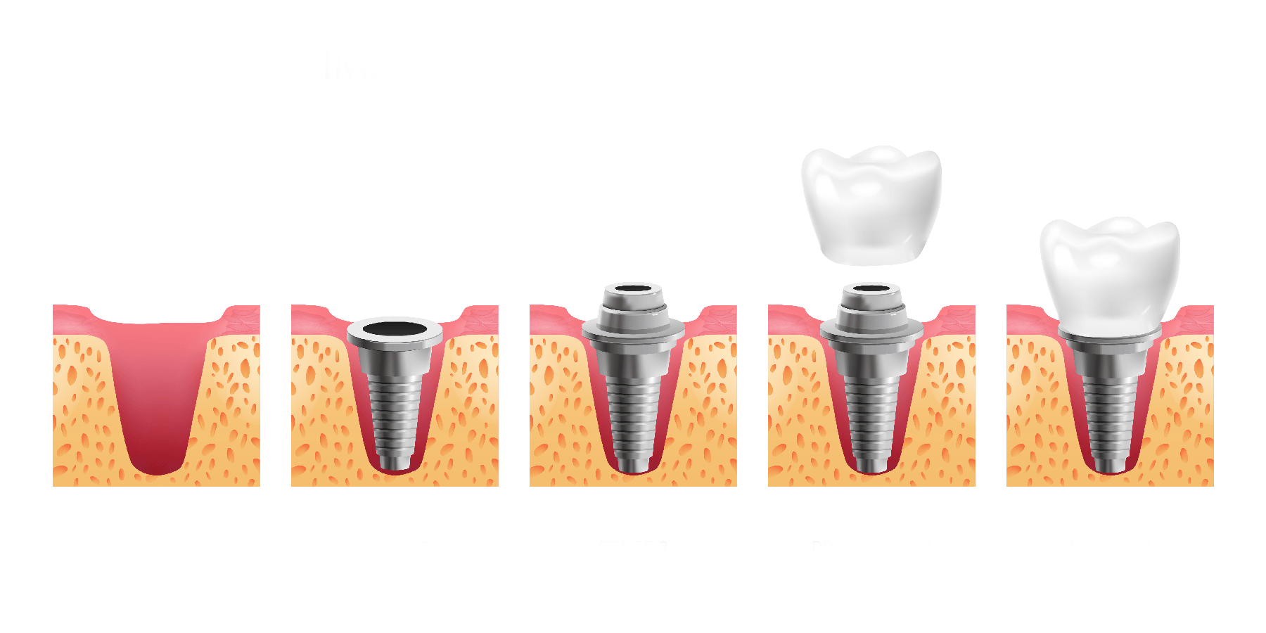 Implante Dentário