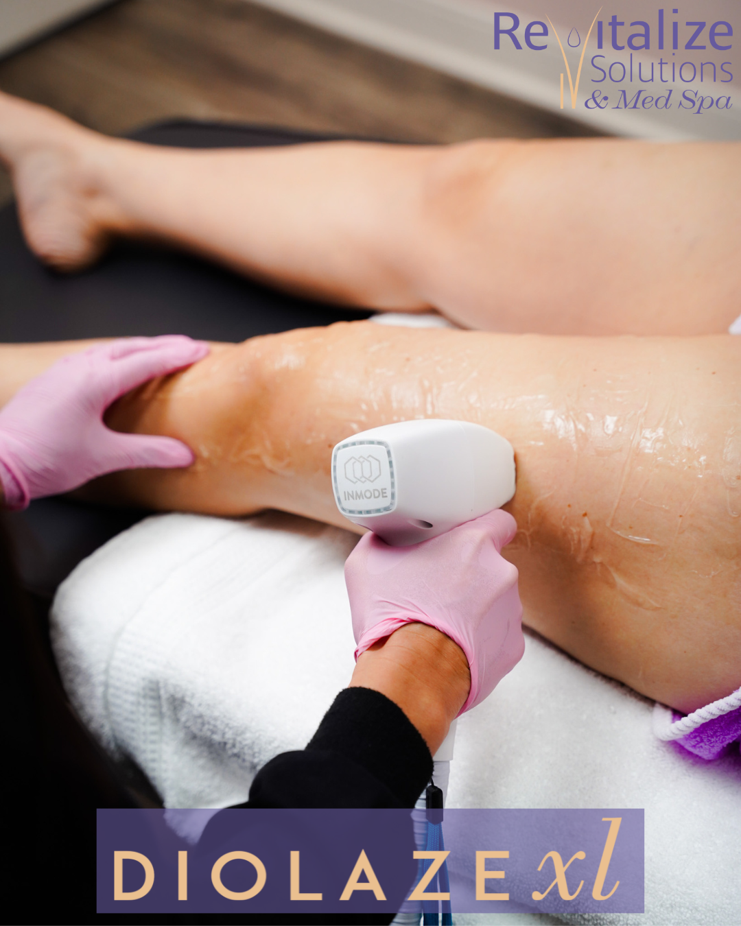 A woman is getting a laser hair removal treatment on her leg.