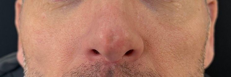 Close-up of a person's nose and mouth, showing light skin and facial hair stubble.