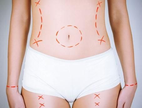 Cirugía plástica en el cuerpo