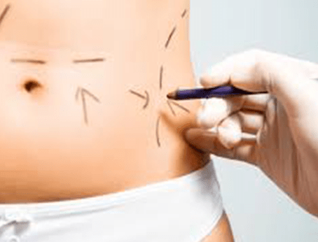 Cirugía plástica en el cuerpo