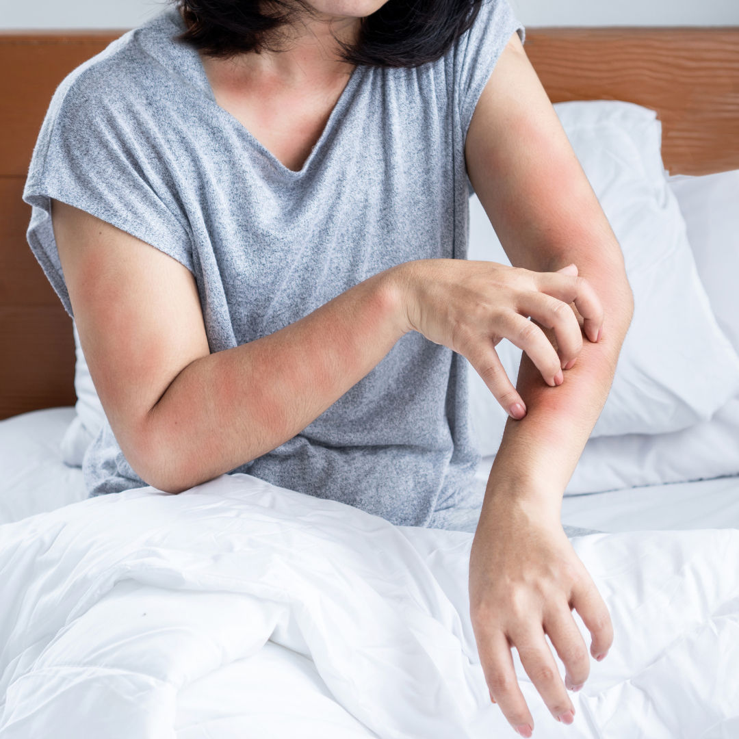 A woman scratching her arm due to bugs biting