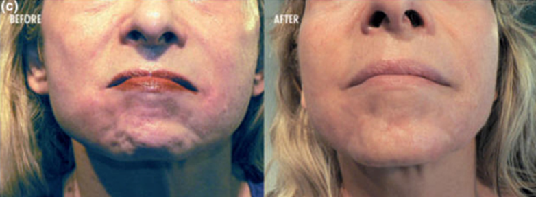 Botox